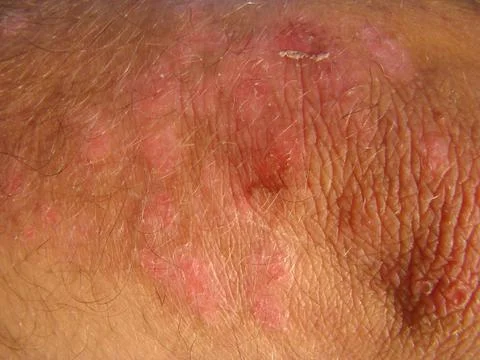 Psoriasis Foto stock