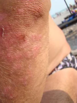 Psoriasis Foto stock