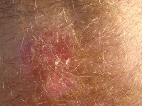 Psoriasis Foto stock