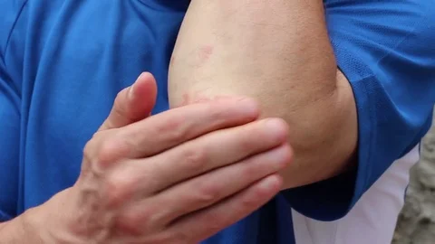 Psoriasis treatment, ointment Stock Footage 76119142