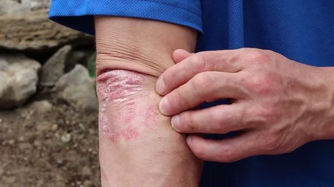 Psoriasis - Treatment. Steroid creams decrease inflammation, relieve itching 動画素材 76119290