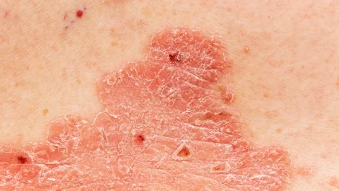 Psoriasis Vulgaris - zoom in to detail o... | Stock Video | Pond5