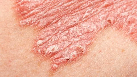 Psoriasis Vulgaris - zoom in to detail o... | Stock Video | Pond5