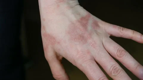 Psychosomatic Allergy to a man's touch (possibly sweat). Perhaps a skin reaction Stock Footage 128996956