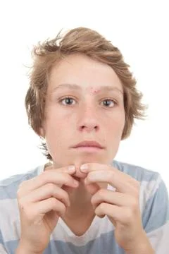 Puberty acne spots Stock Photos