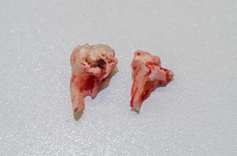 Pulled out sick tooth with caries split into two parts on a white background Stock Photos