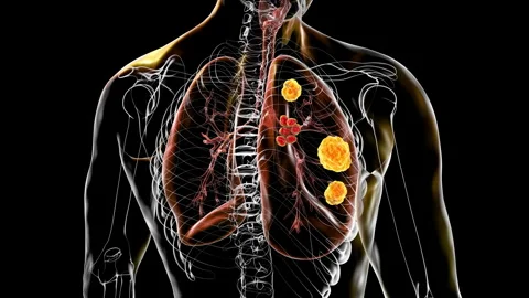Pulmonary blastomycosis, animation Stock Footage 271037289