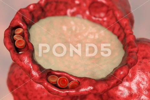 Pulmonary edema, close-up view of alveolus cross-section showing liquid ...