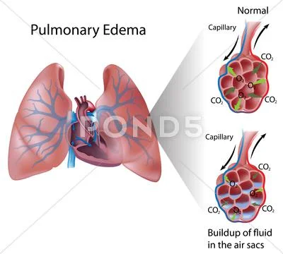 Pulmonary edema Stock Illustration