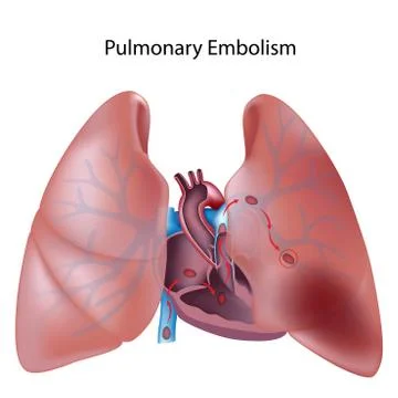 Pulmonary embolism Illustrazione stock