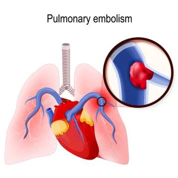 Pulmonary embolism Stock Illustration
