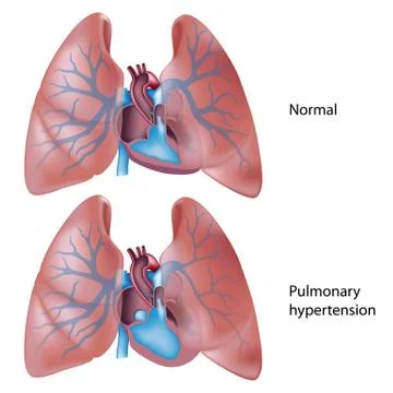 Pulmonary hypertension Stock Illustration