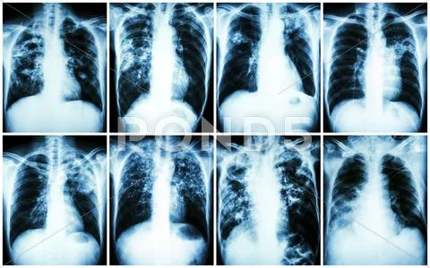 Pulmonary Tuberculosis Collection Chest X Ray Show Patchy Infiltration Interstitial Infiltration Alveolar Infiltration Cavity Fibrosis At Lung Due To Mycobacterium Tuberculosis Infection Stock Images Page Everypixel