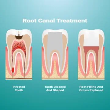 Pulpitis. Root Canal Therapy. Infected Pulp Is Removed From The Tooth And The Stock Illustration