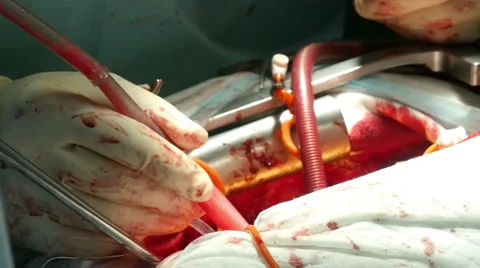 Pumping blood from the peritoneal cavity during surgery 3 Stock-Footage 61036898