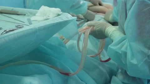 Pumping out fat during liposuction Stock-Footage 67218546