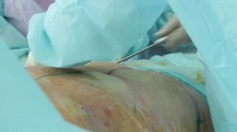 Pumping out fat during liposuction 스톡 동영상 67218685