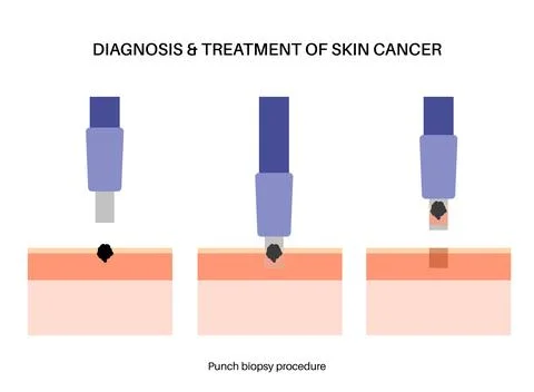 Punch biopsy procedure Stock Illustration