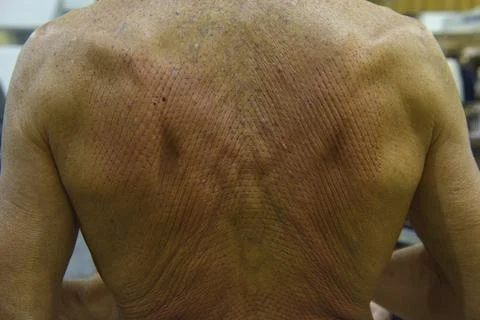 Punctured back of an old man just after massage with acupuncture mat Stock Photos