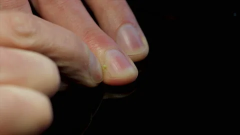 Pus infection of finger nail from bacter... | Stock Video | Pond5