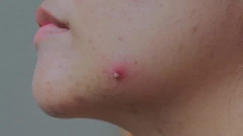 Pustular acne with pus on the face and cheeks of an Asian woman Stock Footage 280331128