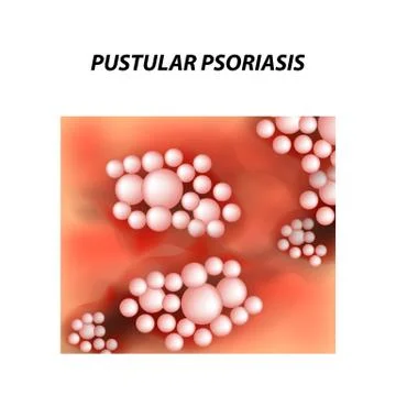 Pustular type psoriasis texture. Eczema, skin disease dermatitis. Infographics Stock Illustration