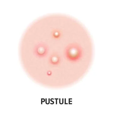 Pustule skin acne type vector icon. Skin disease acne pustules pimples type a Illustrazione stock