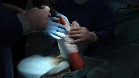 Putting a cast on the hand after surgery Stock Footage 248035863