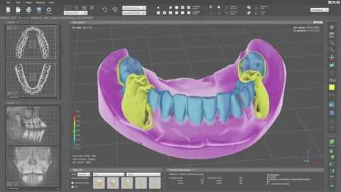 Putting the virtual teeth into the damaged jaw for dental problem treatment Stock Footage 278033941