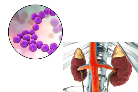 Pyelonephritis caused by bacteria Enterococcus Stock Illustration
