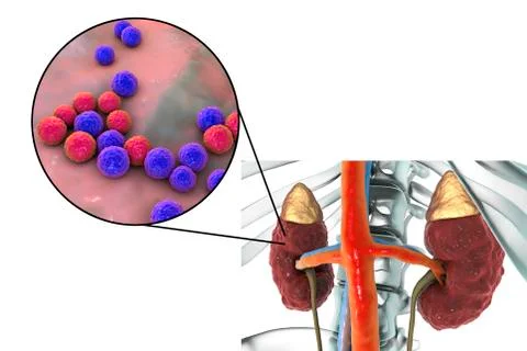 Pyelonephritis caused by bacteria Enterococcus Stock Illustration