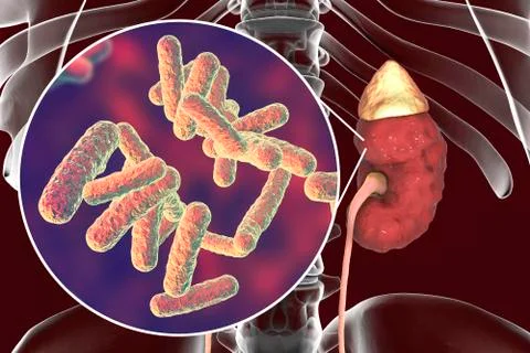 Pyelonephritis, close-up view of bacteria caused kidney inflammation Stock Illustration
