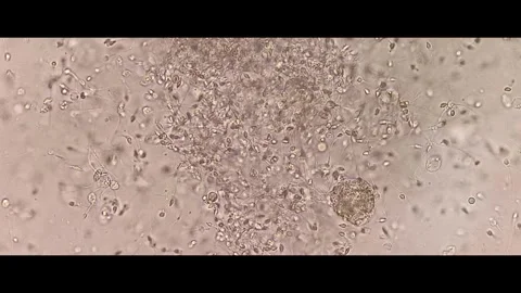 Pyospermia a high number of  pus cell in semen. Video stock 337722930