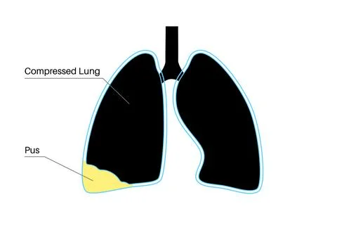 Pyothorax pleural empyema Stock Illustration