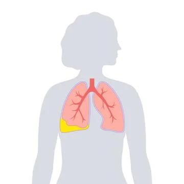 Pyothorax pleural empyema Stock Illustration