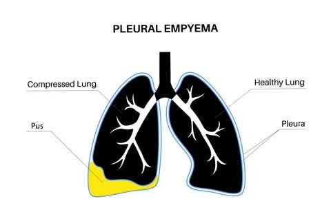 Pyothorax pleural empyema Stock Illustration