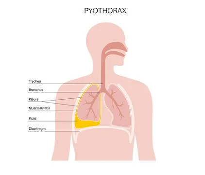 Pyothorax pleural empyema Stock Illustration