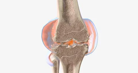 RA is caused by immune cells attacking the body's own synovial membranes, lea Stock Illustration