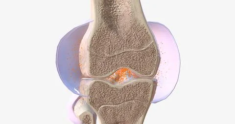 RA is caused by immune cells attacking the body's own synovial membranes, lea Stock Illustration