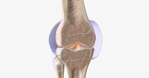 RA is caused by immune cells attacking the body's own synovial membranes, lea Stock Illustration