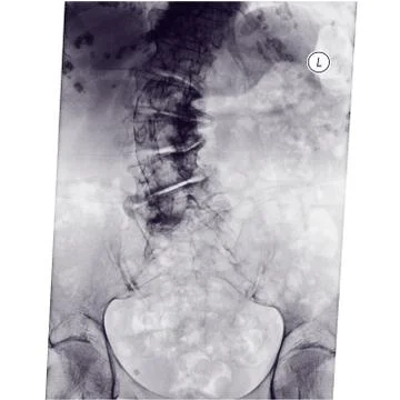 Radilogy  x-rays image of spine scoliosis  Stock Photos