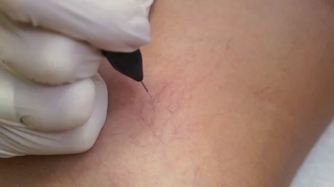 Radiofrequency coagulation and laser removal of blood vessels Stock Footage 72541199