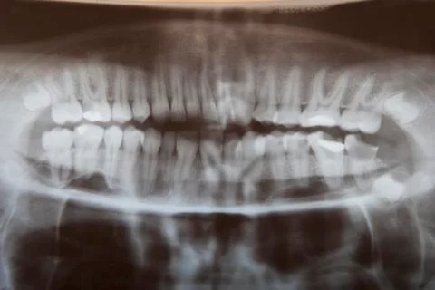 Radiograph teeth Stock Photos