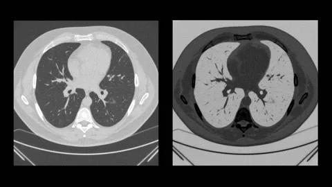 Radiological computed tomography of the lungs for research on coronavirus Stock Footage 130919246