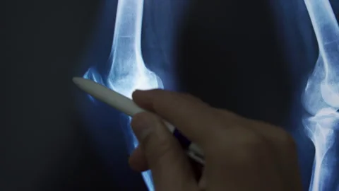 Radiologically analyzing the knee Vidéo 277116785