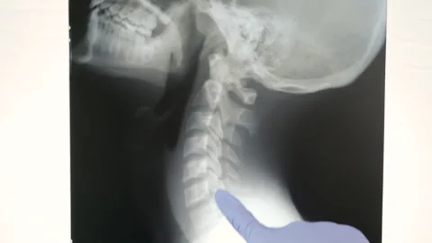 Radiologically analyzing the neck spinal column Stock-Footage 287473513