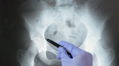 Radiologically analyzing the pelvic bone with x-ray Stock-Footage 277116801