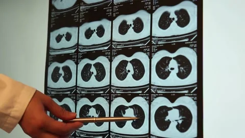 Radiologist Examining Chest CT Scans Stock Footage 341123999