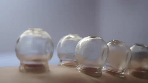 Raditional Fire Cupping Therapy Session Stock Footage 327516224