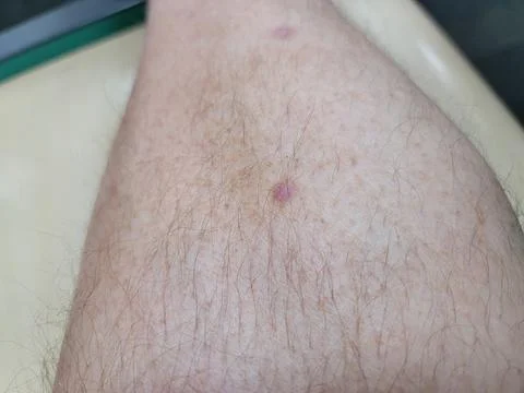 Raised red bump or pox on male leg with hair Stock Photos